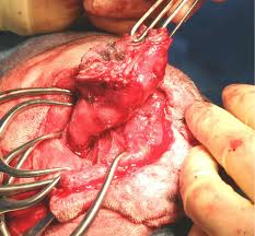 An ear canal being dissected free of the surrounding tissue. 